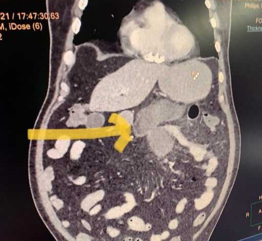 Biopsy confirmed Black Fungus of small intestine