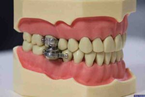 dental-weight-loss-magnet -Dental-Slim Diet Control