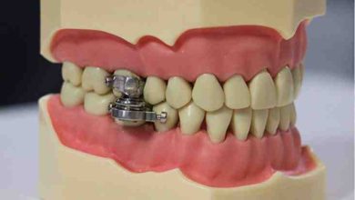 dental-weight-loss-magnet -Dental-Slim Diet Control