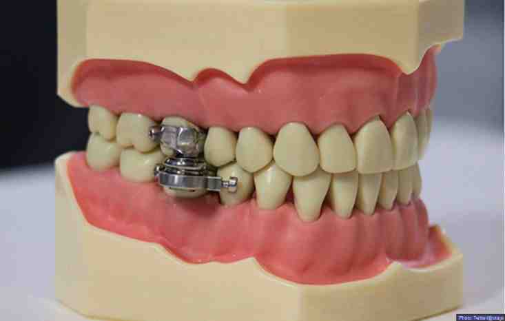 dental-weight-loss-magnet -Dental-Slim Diet Control