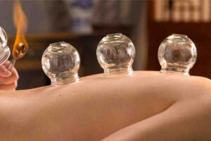 Benefits of Cupping-حجامہ