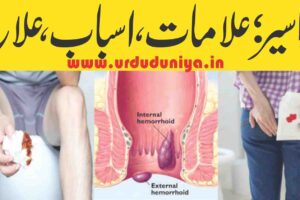 piles-or-hemorrhoids-signs-causes-treatment