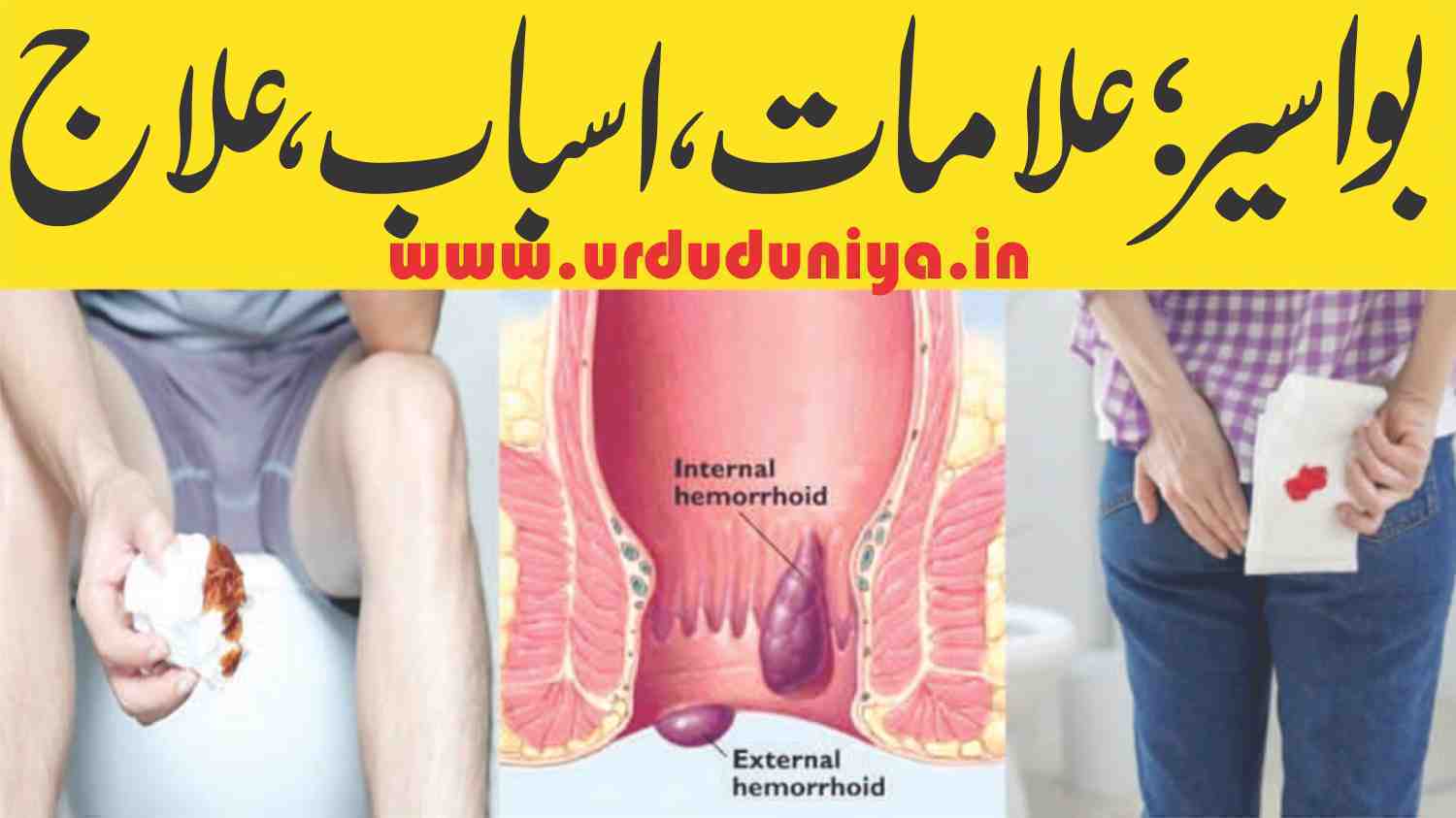 piles-or-hemorrhoids-signs-causes-treatment