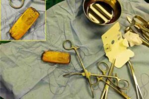 Egypt : Doctors remove mobile phone from patient's abdomen