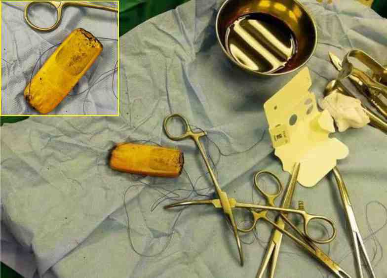 Egypt : Doctors remove mobile phone from patient's abdomen