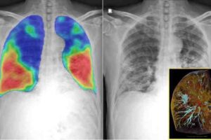 new-research-the-worlds-brightest-x-ray-machine-100-times-better-than-ct-scan-hierarchical-phase-contrast-tomography