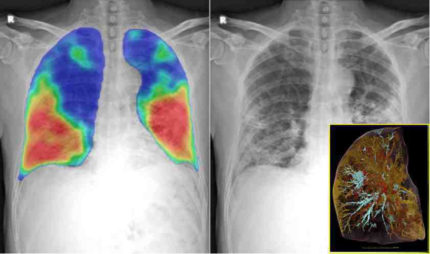 new-research-the-worlds-brightest-x-ray-machine-100-times-better-than-ct-scan-hierarchical-phase-contrast-tomography