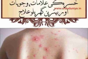 chicken pox treatment