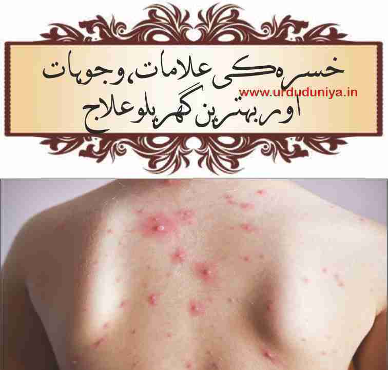 chicken pox treatment