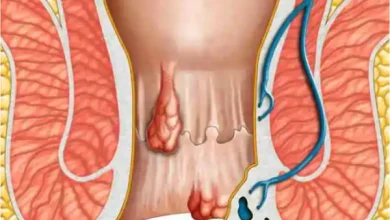 bawasir treatment rahimi shafakhana