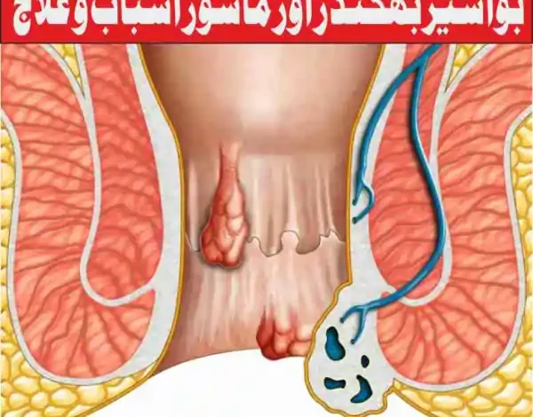 bawasir treatment rahimi shafakhana