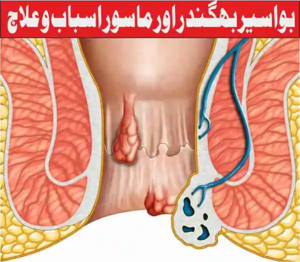 bawasir treatment rahimi shafakhana