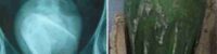 the-glass-was-removed-from-the-private-part-of-the-45-year-old-woman-through-the-operation-which-stunned-the-doctors