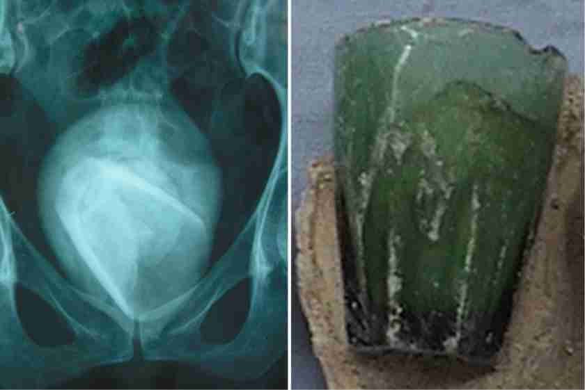 the-glass-was-removed-from-the-private-part-of-the-45-year-old-woman-through-the-operation-which-stunned-the-doctors
