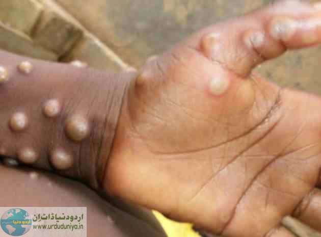 monkeypox