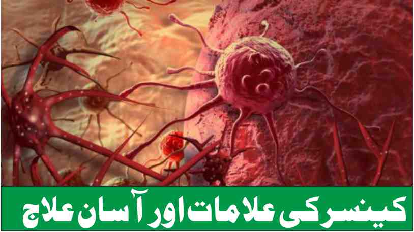 cancer symptoms and easy treatment