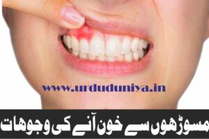 causes of bleeding gums