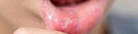 causes of mouth sores and inflammation