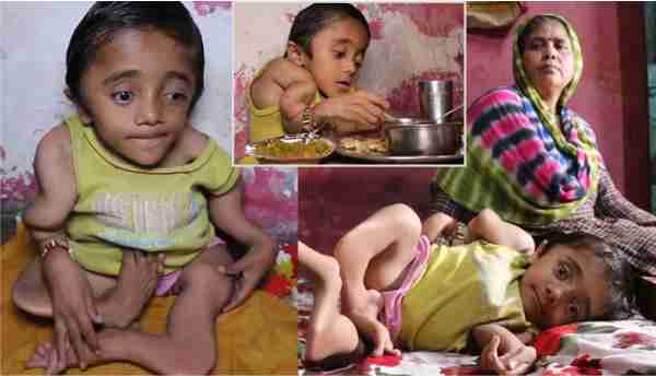 osteoporosis uttar pradesh bone disease