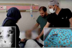 turkey news coins batteries magnets operated on the stomach of a citizen by the doctor surprised