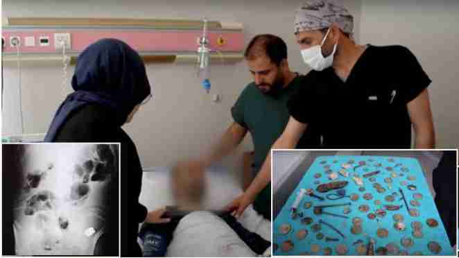 turkey news coins batteries magnets operated on the stomach of a citizen by the doctor surprised