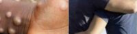 monkeypox an epidemic spread through homosexual sex