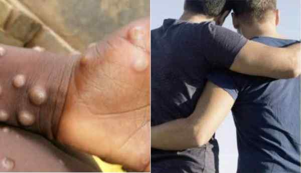 monkeypox an epidemic spread through homosexual sex
