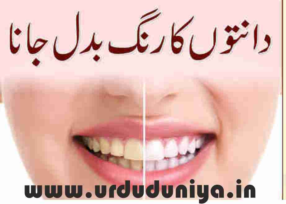 discoloration of teeth