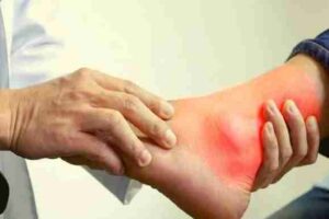 how to lower uric acid naturally