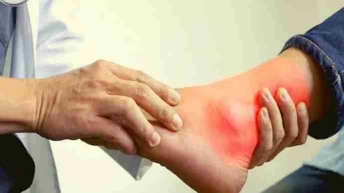 how to lower uric acid naturally