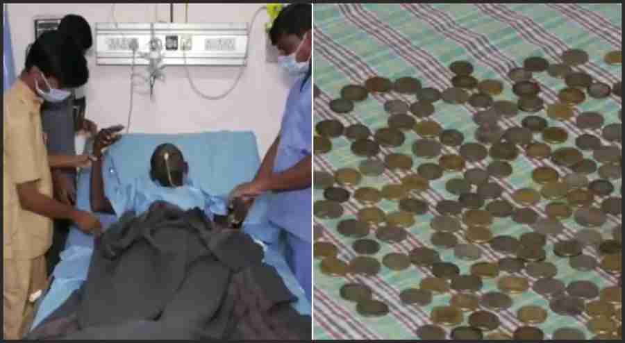 karnataka 187 coins extracted from man stomach