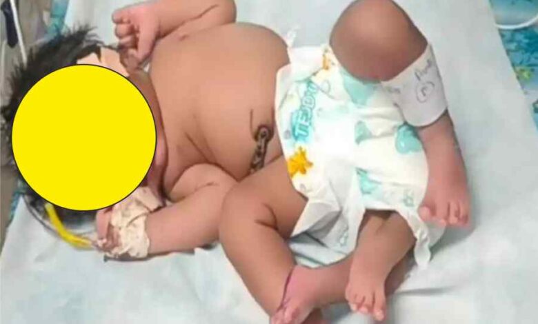 gwalior woman gives birth to baby girl with 4 legs