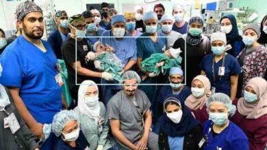 two iraqi conjoined twins in saudi arabia were successfully separated