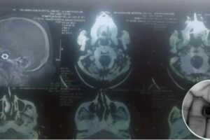 tamil nadu negligence of govt vellore medical college hospital doctors treated but left the iron nut in the head as it is