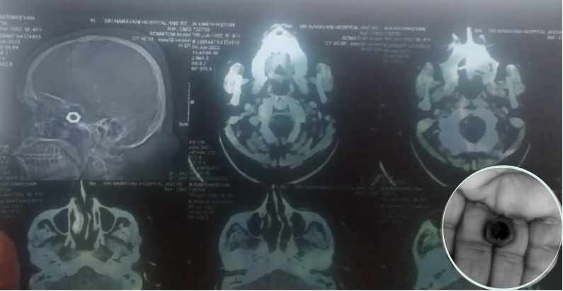 tamil nadu negligence of govt vellore medical college hospital doctors treated but left the iron nut in the head as it is