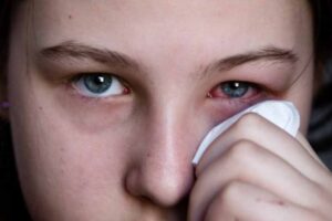 eye flu eye infection