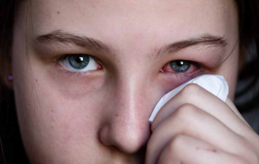 eye flu eye infection