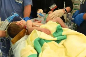 saudi medical team surgery to separate conjoined syrian twins