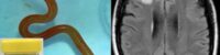 a worm found in snakes was found in the brain of a woman in australia