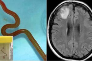 a worm found in snakes was found in the brain of a woman in australia