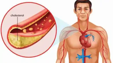 high cholesterol signs