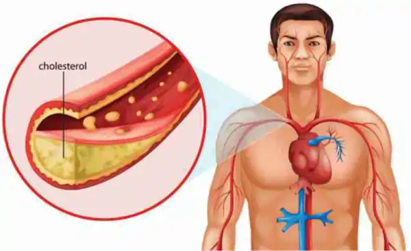 high cholesterol signs