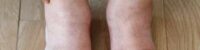 swelling in your feet