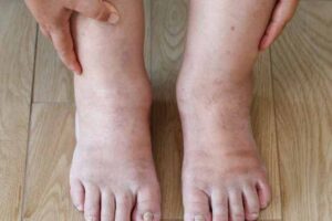 swelling in your feet