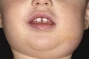 mumps infection
