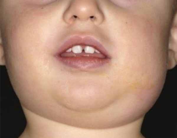 mumps infection