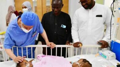 conjoined twins saudi