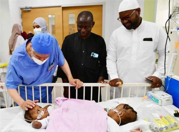 conjoined twins saudi