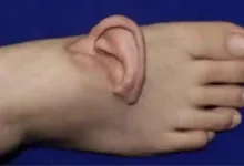 china ear surgery foot grafting