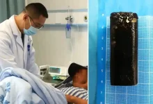 lighter removed from stomach china hospital